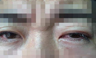 济源男子花千元纹美瞳线，不料眼角膜受损住进医院
